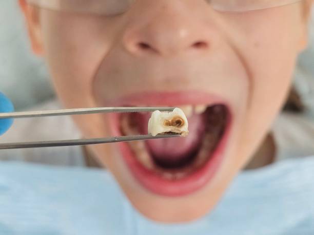 Best Emergency Wisdom Teeth Removal in Lepanto, AR